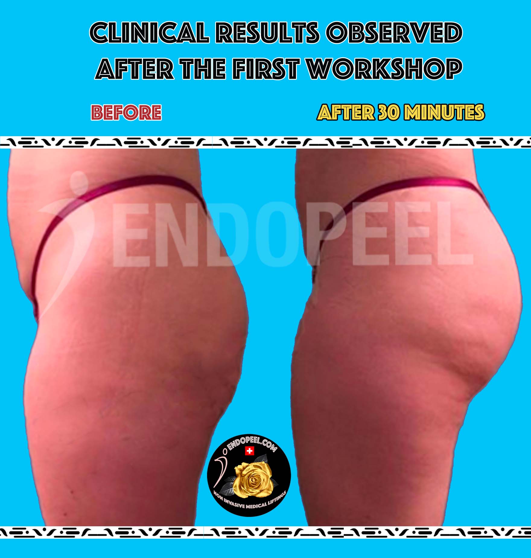 Ergebnisse nach dem 1. Workshop Gluteoplastik