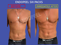 ボディ Endopeel