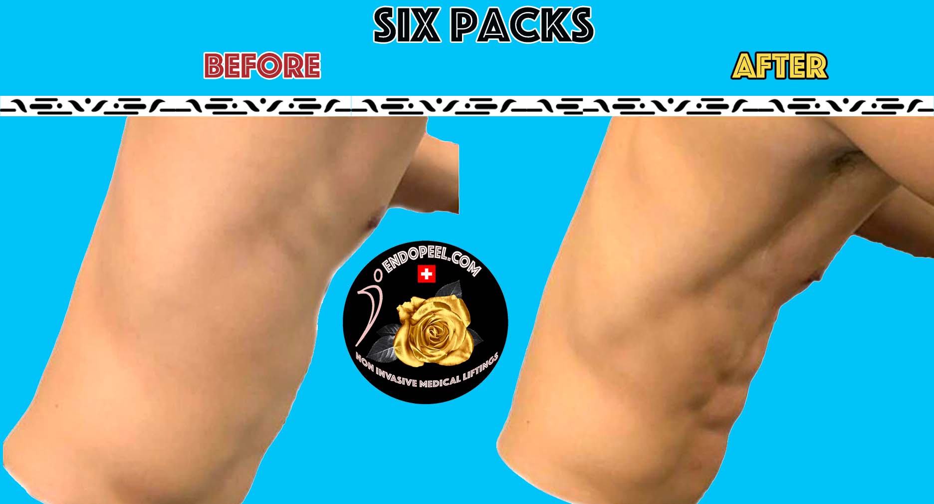 Sixpacks durch Endopeel