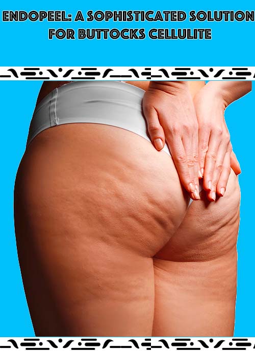 buttocks-cellulite buttocks-cellulite