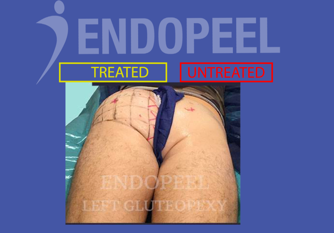 Umformung atropher Gesäßmuskeln nach Trauma mit Endopeel