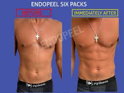 Endopeel Körper