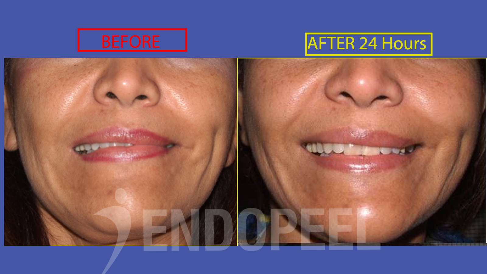 Endopeel und Fazialisparese