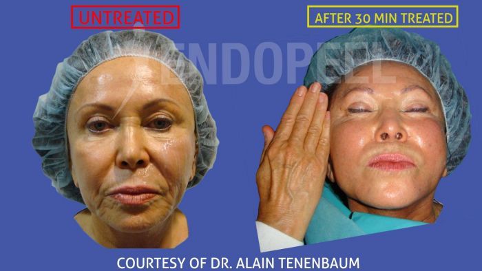 Gesicht und Hals mit Endopeel