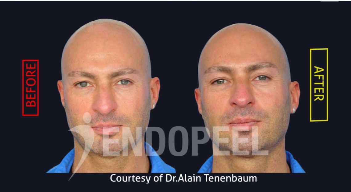 rinoplastia con endopeel