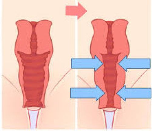 Vaginalwandstraffung